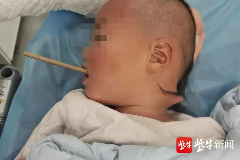 太揪心！一根筷子把2岁多孩子的脖子戳穿！